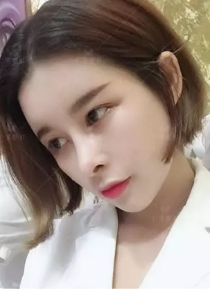 本人在广州广美做完鼻综合+自体脂肪填充后都说我立变欧美范