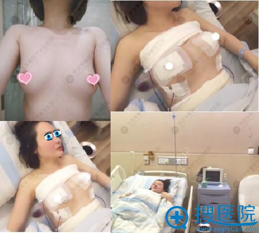 从飞机场到波波公主的秘密 我在四川华美紫馨隆胸如此自然真实
