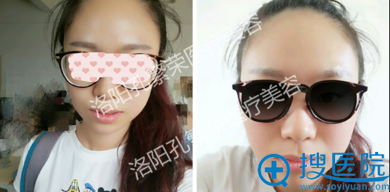 术后第二天,脸部稍微有点肿 术后第二天,脸部稍微有点肿