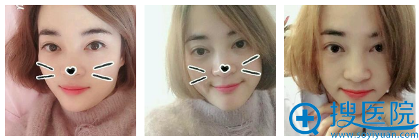 ���ϼ����˫��Ƥ�����Ļָ����