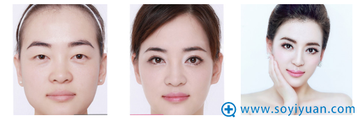 石家庄哪做双眼皮好?看我找星源李海霞做的双眼皮效果图就知道