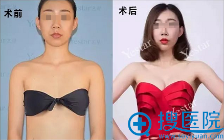 在武汉yestar做了宫廷隆胸 我迎来了一段浪漫的跨国恋