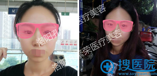 注射的效果怎么样?洛阳孔繁荣整形医院案例恢复过程图