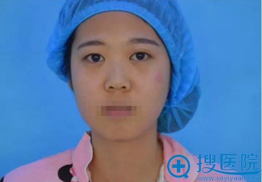 郑州至美假体隆鼻+双眼皮术前照 郑州至美假体隆鼻+双眼皮术前照