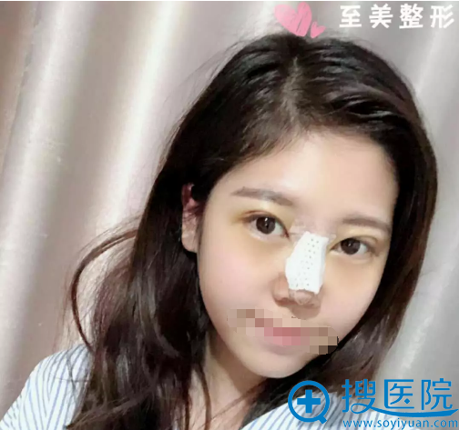 小美手术完成即刻的术后照 小美手术完成即刻的术后照