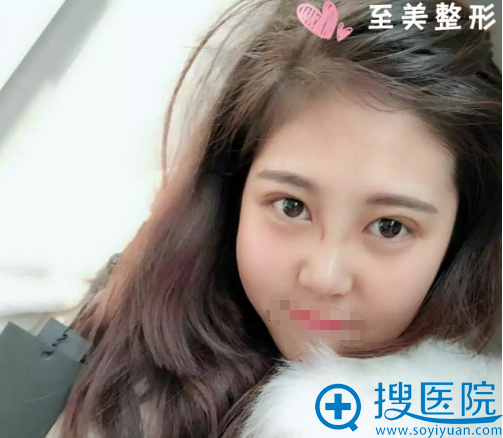 小美拆线后的眼睛鼻子效果 小美拆线后的眼睛鼻子效果