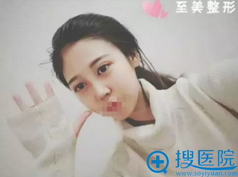 眼部吸脂+假体隆鼻术后20天效果 眼部吸脂+假体隆鼻术后20天效果
