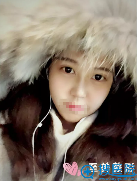 郑州至美双眼皮+隆鼻三个月术后照 郑州至美双眼皮+隆鼻三个月术后照