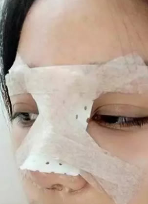 还为你的塌鼻子发愁?在玉林华美鼻综合摆脱鼻梁低鼻子短的经历