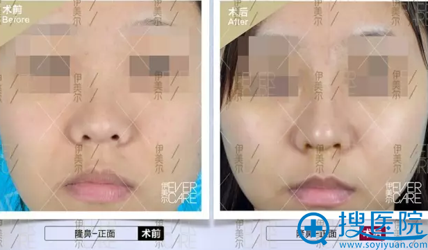 黄志祥芭比翘鼻手术真人案例 黄志祥芭比翘鼻手术真人案例