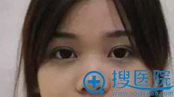 隆鼻手术前的塌鼻子 隆鼻手术前的塌鼻子