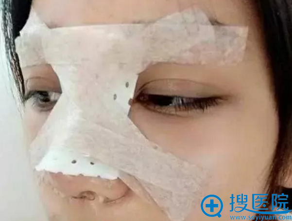 玉林华美鼻综合手术当天效果 玉林华美鼻综合手术当天效果