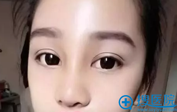 刚拆线的鼻子 刚拆线的鼻子