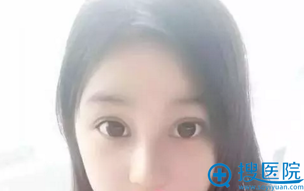 玉林华美鼻综合手术15天恢复照 玉林华美鼻综合手术15天恢复照
