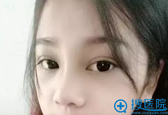 鼻综合整形手术1个月恢复样子 鼻综合整形手术1个月恢复样子