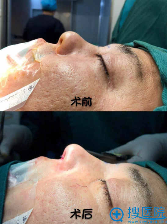 何栋良院长鼻基底填充和隆鼻案例 何栋良院长鼻基底填充和隆鼻案例