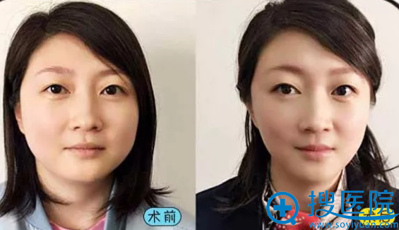 福州鼓楼整形医院案例 福州鼓楼整形医院案例
