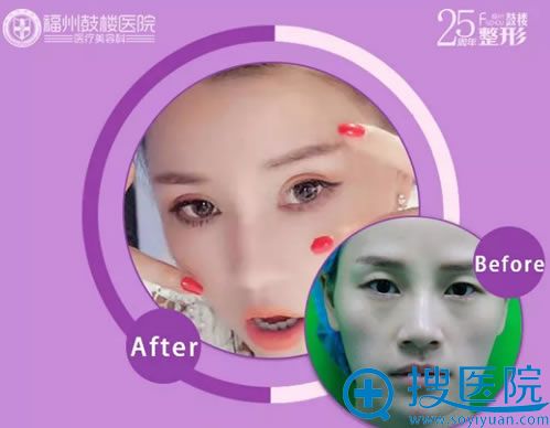 福州鼓楼双眼皮手术真人案例 福州鼓楼双眼皮手术真人案例