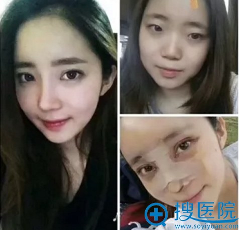 鼻综合整形手术前后效果对比图 鼻综合整形手术前后效果对比图