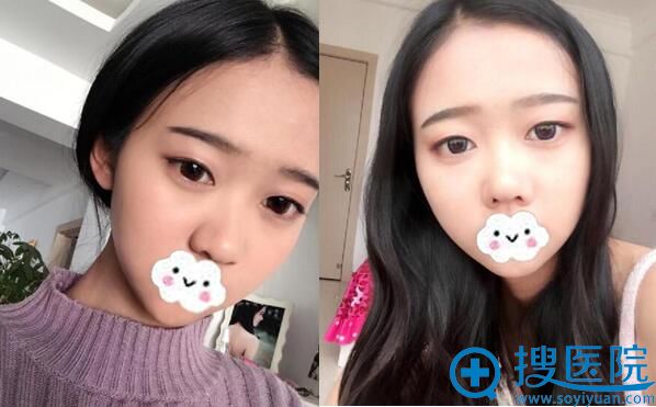 单眼皮限制了我眼睛光芒 昆明艺星为我做双眼皮手术把我变女神
