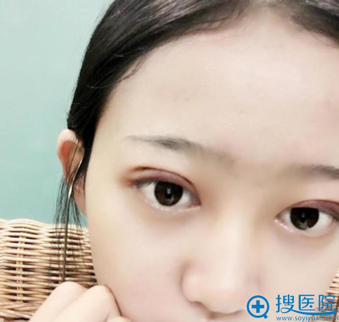 术后3天,眼睛还有点肿 术后3天,眼睛还有点肿