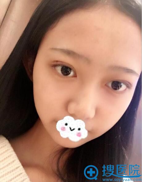 术后一周,今天该拆线了 术后一周,今天该拆线了