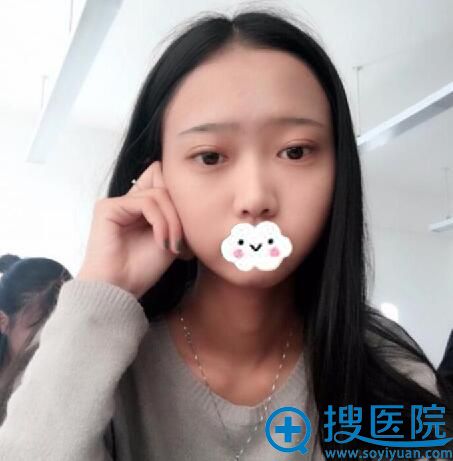 术后15天,即使素颜也好看 术后15天,即使素颜也好看