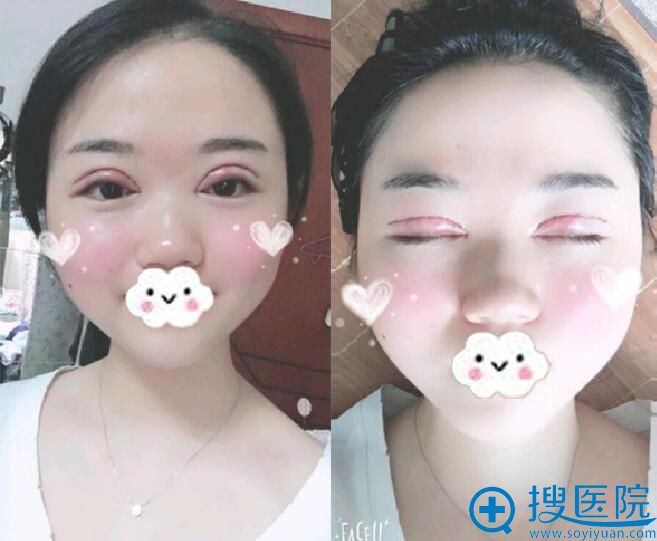 术后天,眼睛有点肿 术后天,眼睛有点肿