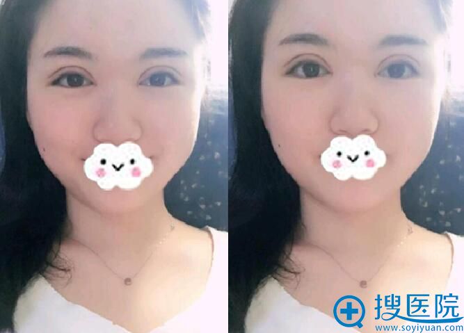 术后第5天,眼部肿有些消退 术后第5天,眼部肿有些消退