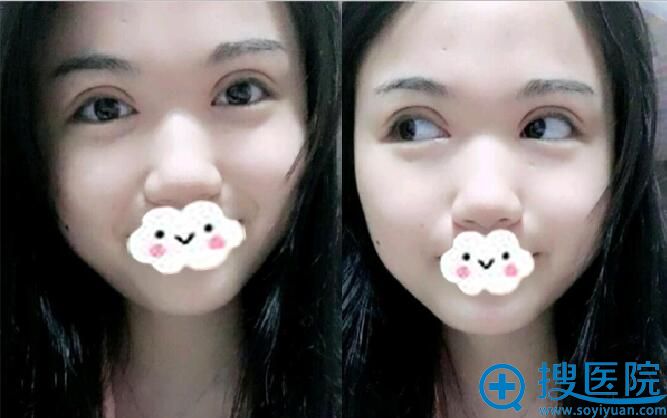 术后第8天,我是大眼妹纸 术后第8天,我是大眼妹纸
