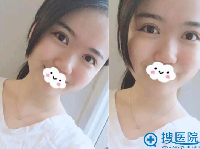 术后50天,超喜欢现在的自己 术后50天,超喜欢现在的自己