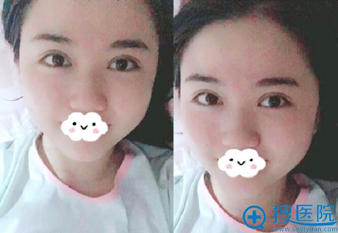术后70天,感觉完全恢复 术后70天,感觉完全恢复