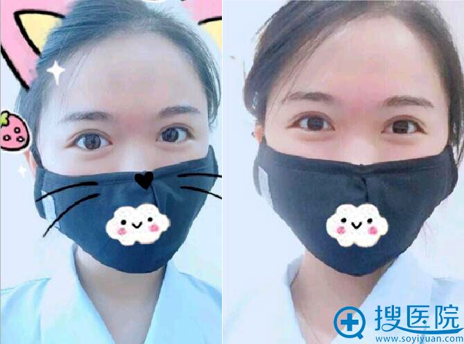 术后3个月了,现在超自然 术后3个月了,现在超自然