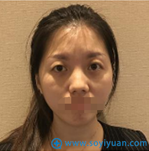 有好奇温州星范陈德裕切开双眼皮效果的吗?分享我术后恢复照