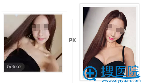 Amy自体脂肪丰胸前后变化 Amy自体脂肪丰胸前后变化