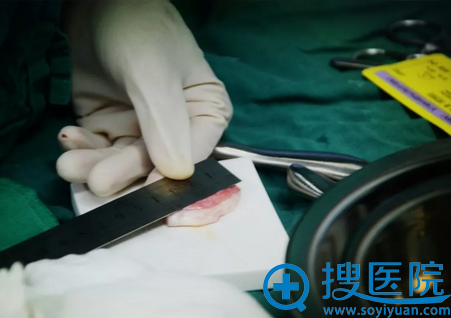 手术第二步:肋软骨的采集量 手术第二步:肋软骨的采集量