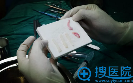 雕刻成形的肋软骨 雕刻成形的肋软骨