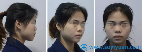 孙华刚肋软骨重建鼻中隔、重塑鼻头鼻尖术前 孙华刚肋软骨重建鼻中隔、重塑鼻头鼻尖术前