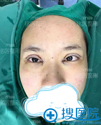 深圳铭医切开双眼皮+开眼角术后即刻 深圳铭医切开双眼皮+开眼角术后即刻