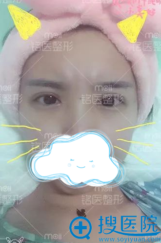 双眼皮+开眼角拆线后效果 双眼皮+开眼角拆线后效果