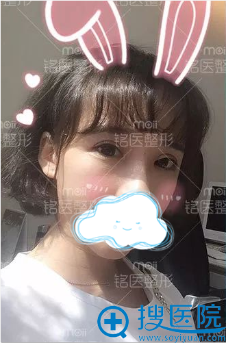 双眼皮术后化了淡妆的橙子 双眼皮术后化了淡妆的橙子
