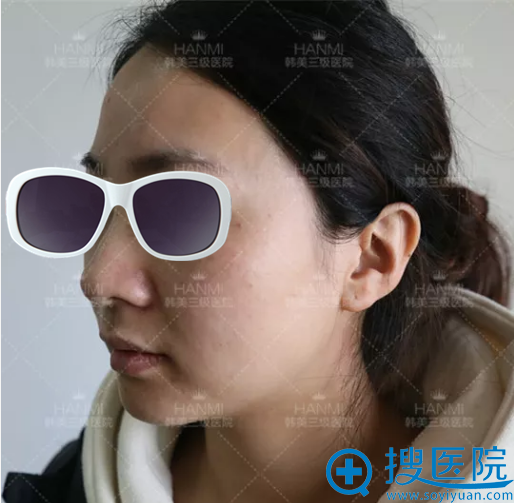 直击安徽韩美祛斑真人秀术后效果 献给奋斗在祛斑线的老铁