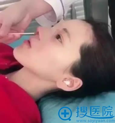 假体隆鼻和耳软骨垫鼻尖术后第1天 假体隆鼻和耳软骨垫鼻尖术后第1天