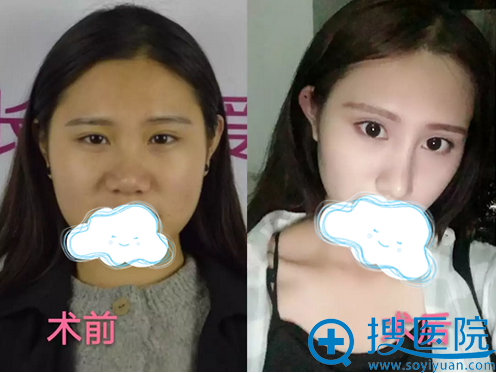 看我硅胶隆鼻前后变化大不大 看我硅胶隆鼻前后变化大不大