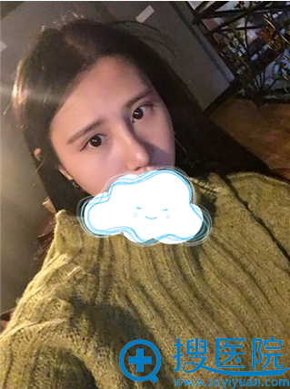 隆鼻拆线后,看起来就美美哒 隆鼻拆线后,看起来就美美哒
