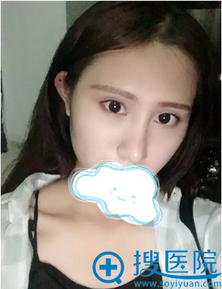 黄志鹏院长给我做的鼻子好漂亮 黄志鹏院长给我做的鼻子好漂亮