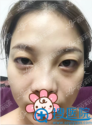 这位小姐姐找西安美好何琪做的重睑术+内眦成形术 效果你喜欢吗