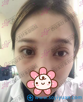 ����˫��Ƥ���ߺ��۾���Щ��