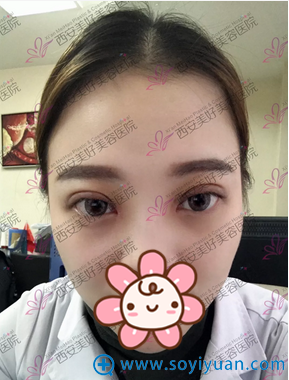 ˫��Ƥ+���۽ǰ���»ָ�Ч��