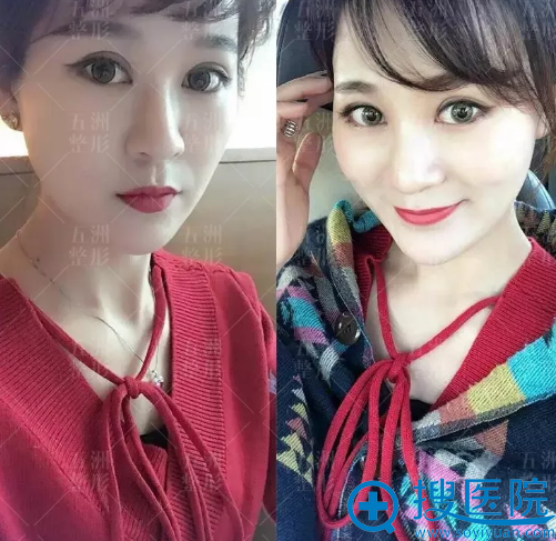 双眼皮术后效果图 双眼皮术后效果图